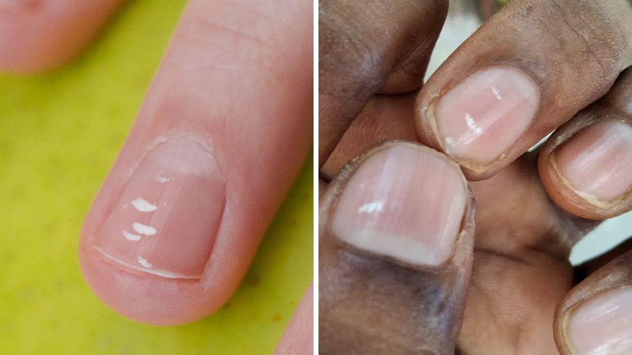 causes of White Spots on Nails